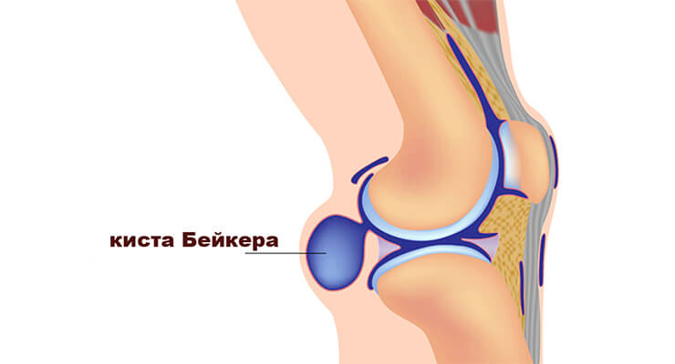 Клинит колено при ходьбе